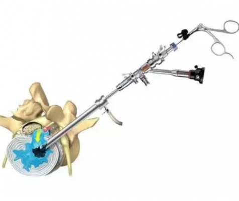 脊柱內窺鏡spinal endoscope