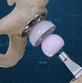 人工髖關(guān)節g7 acetabular system