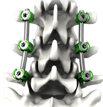胸腰椎后路釘棒內固定系統大博